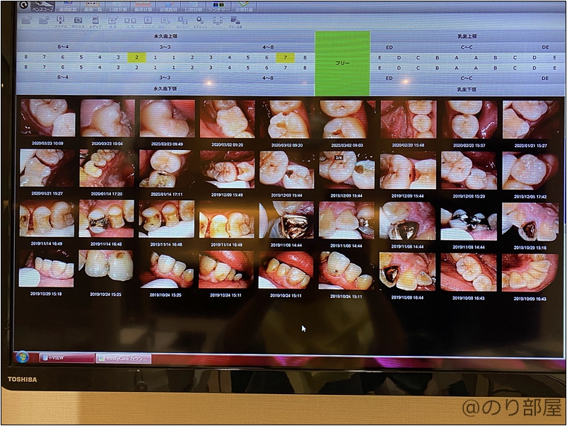 治療中の写真 さいたま市の伊藤歯科医院は治療の画像を記録し説明をしてくれます 【口コミ･感想】【口コミ･感想】伊藤歯科医院は残念な面もあるけど全体的に良い｡【さいたま市の歯医者】