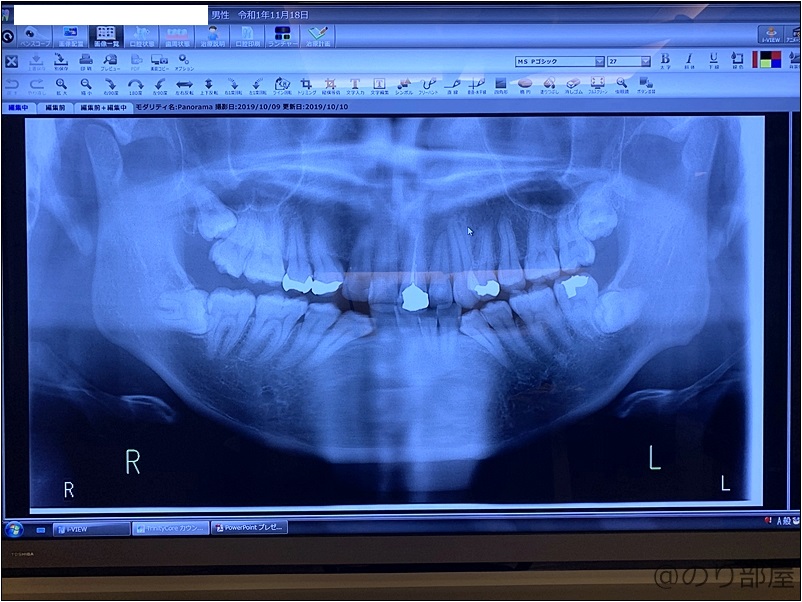 治療前のレントゲン写真 さいたま市の伊藤歯科医院は治療の画像を記録し説明をしてくれます 【口コミ･感想】【口コミ･感想】伊藤歯科医院は残念な面もあるけど全体的に良い｡【さいたま市の歯医者】