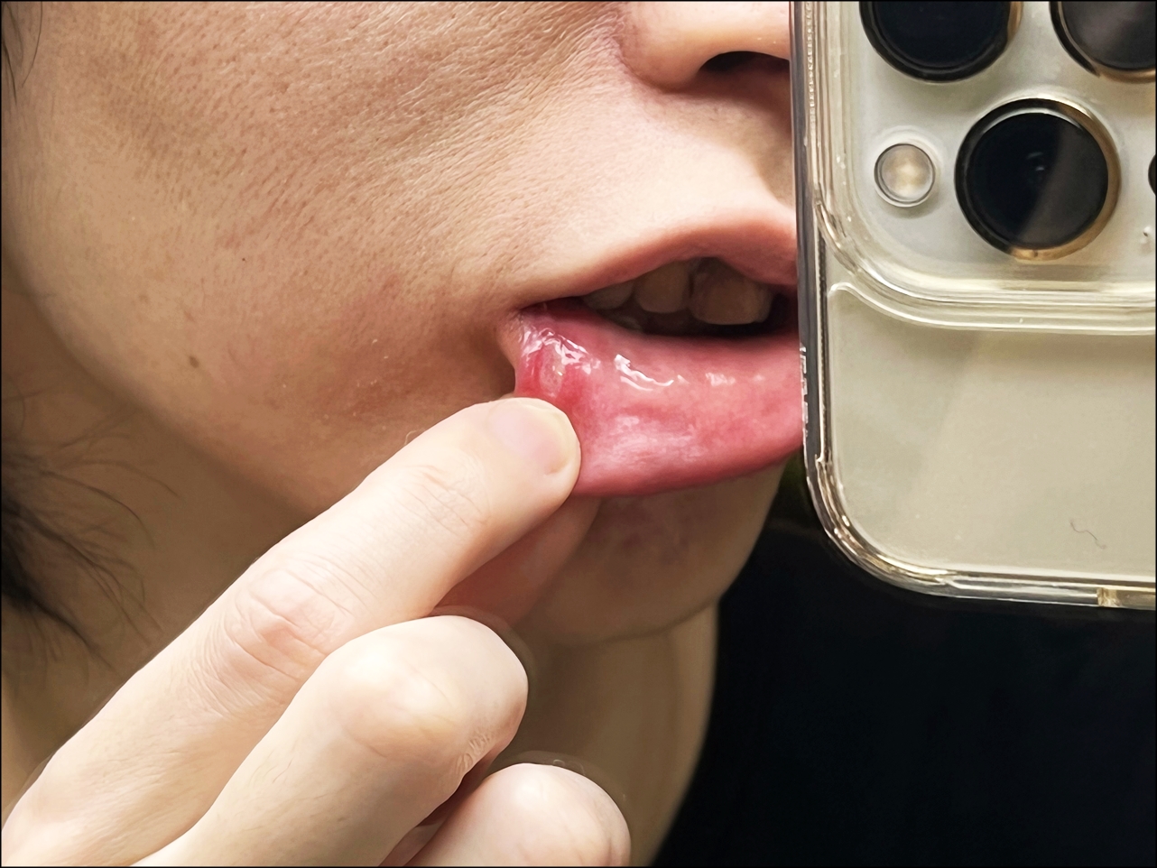 口内炎を早く治すパッチ薬「トラフルダイレクトa」を実際に口に貼り付けます 口内炎を早く治す方法。痛いしみる症状を和らげるオススメの薬の紹介。ビタミン摂取も回復に役立ちます。